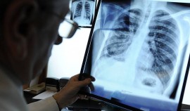 В России заболеваемость туберкулёзом достигла минимума за все время наблюдений