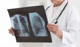 Эффективность лечения впервые выявленного туберкулёза в Чеченской Республике достигла 90%| грозный, чгтрк