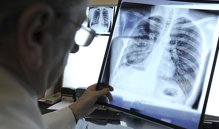 В России рекордно снизилась смертность от туберкулёза